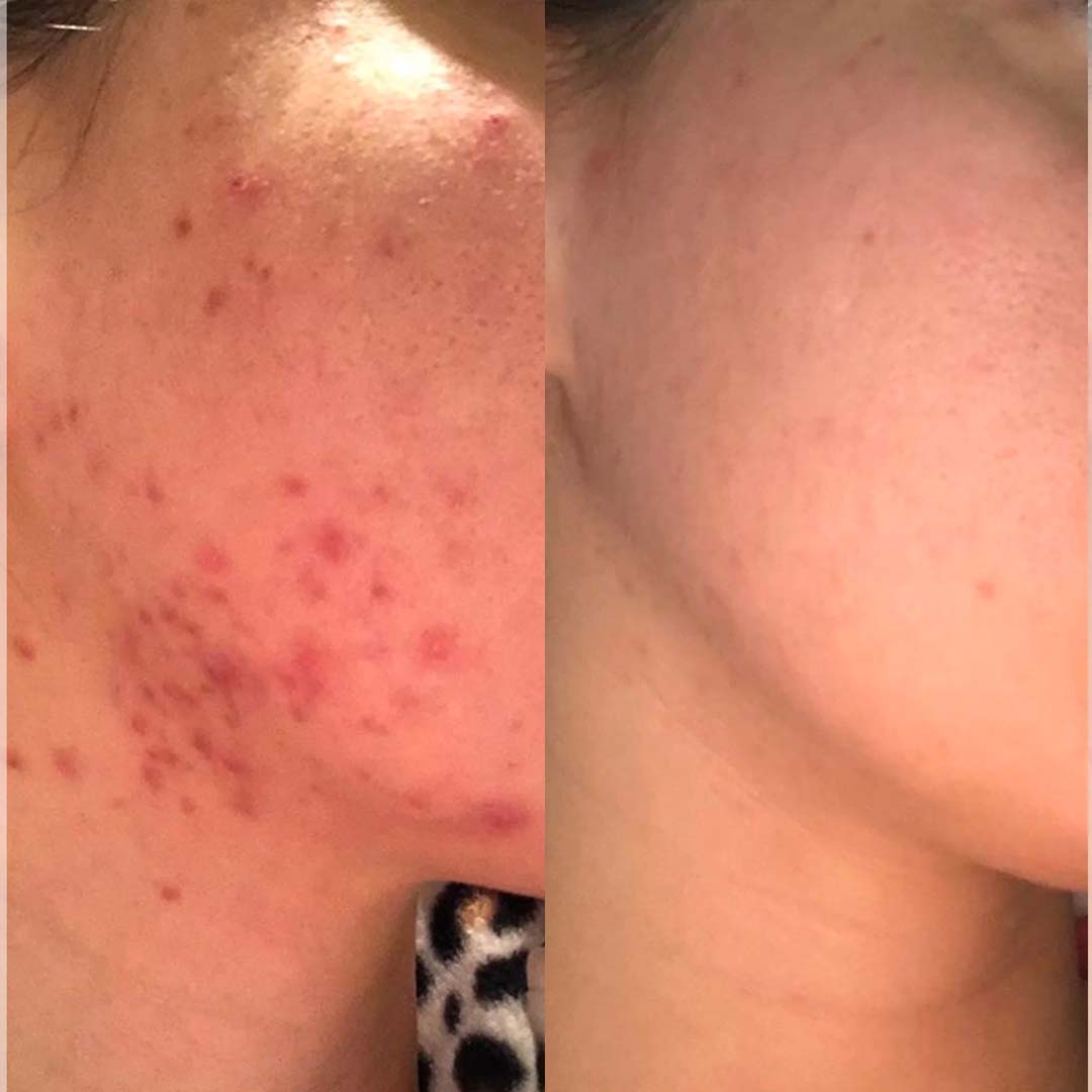 Herbolist Collageen Acne Vitamines